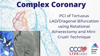 PCI of Tortuous LADDiagonal Bifurcation using Rotational Atherectomy amp MiniCrush Technique Nov 2023 [upl. by Anuaf]