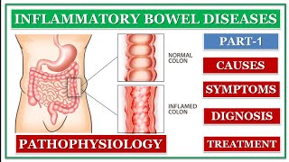 INFLAMMATORY BOWEL DISEASES  PART1  CROHNS DISEASE  ULCERATIVE COLITIS  DETAIL EXPLANATION [upl. by Arema]