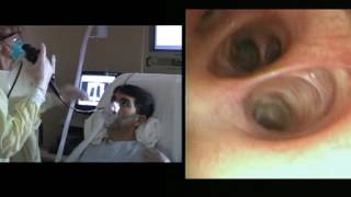 Bronchoscopy with BAL [upl. by Shaine]