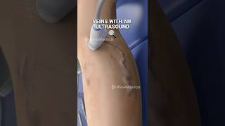 Super glue for your veins 3D Animation [upl. by Nilatak]