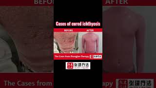 Treatment case of ichthyosis skin of belly ichthyosis skincare dermatologist dryskinremedy [upl. by Kerianne258]