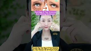 Eye Bags amp Tear Grooves Are Getting Shallower eyelift eyeexercise yoga faceyoga facialyoga fit [upl. by Phyllis426]