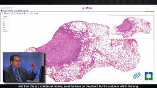 Pathology Insights Lung Granulomas Caused by Fungal Infection with Sanjay Mukhopadhyay MD [upl. by Vashtee]