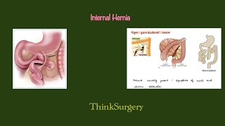 Internal Hernia Brief review with complete explanation [upl. by Lotsyrk11]