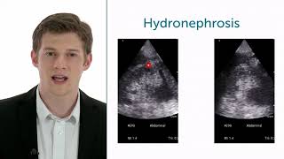 How To Evaluate Hydronephrosis In Point of Care Ultrasound [upl. by Sorkin]