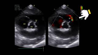 Pulmonary hypertension in an 15yearold female dog with recent syncopal episodes [upl. by Hahsia]