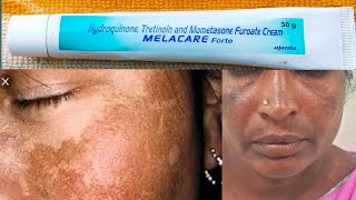 Pigmentation cream  MELACARE forte cream  Melacare forte cream  Kannadathihelthandbeautytips [upl. by Nivri903]