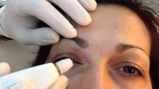 Not Surgical aesthetic blepharoplasty with PLEXR [upl. by Koziara]