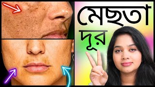 ✔ মেছতা দূর করার বৈজ্ঞানিক উপায় । How to Treat MELASMA [upl. by Lynsey923]