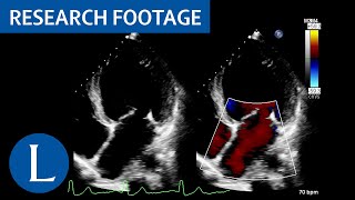 Dilated left ventricle with global hypokinesia LibmanSacks endocarditis 1 of 4 [upl. by Adelle]