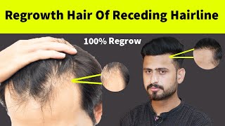 Its Truth  Regrowth Receding Hair line Hair Naturally  How To Regrowth Hair Line Naturally [upl. by Aratehs556]