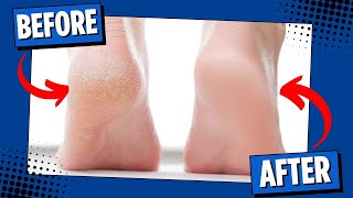 How to Get Rid of Calluses on Feet Fast  Super Easy Methods [upl. by Norene595]