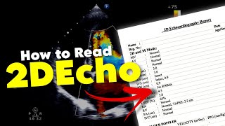 2DEcho  How to READ 2DEcho report  Echocardiography • Daily Cardiology [upl. by Floridia]