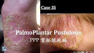 Palmoplantar pustulosis PPP 掌跖脓疱病 [upl. by Ellett]