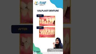 VALPLAST DENTURE dentist dokterbehelmalang doktergigimalang doktergigimalangraya dentalclinic [upl. by Neahs614]