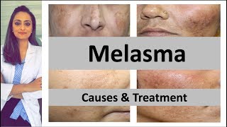 How to treat dark spots  Melasma  Causes amp treatment  Dermatologist  Dr Aanchal Panth [upl. by Dnaltruoc]