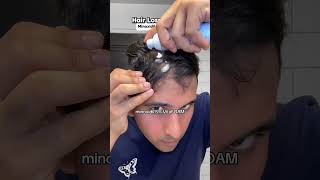 Day250 of Applying Minoxidil Restoring Hairlinebald minoxidil minoxidilresult hairloss [upl. by Comstock]