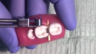 tofflemire matrix band placement For Class II amalgam شرح عربي مبسط [upl. by Akimet]