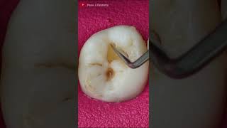 Small Teeth Cavities toothrestoration satisfying [upl. by Wertz]