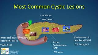 Natural History of Pancreatic Cysts What Becomes of Them [upl. by Nhepets]