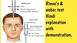 Rinne amp Weber test demonstration in Hindi explanation msn gnmcourse nursing ear [upl. by Epilihp]