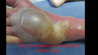 Cellulitis Foot With Blister [upl. by Annahoj]