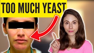 6 SIGNS OF TOO MUCH YEAST SKIN DrDrayzday [upl. by Trueman749]