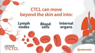 CTCL can move beyond the skin [upl. by Yoj]