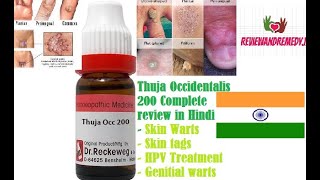 Thuja Occidentalis 200 Complete Review in Hindi  Best Homeopathic Solution for Warts and skin bumps [upl. by Amii]