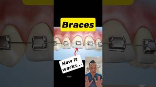 How Do Braces Move Your Teeth The Magic of Orthodontics dentallan dentist shorts [upl. by Odawa557]