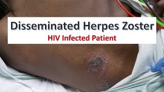 Disseminated Herpes Zoster Infection in an HIV Patient [upl. by Romelda53]