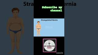 Animation of Strangulated hernia with explanation4k 3danimation trending shortvideo doctor [upl. by Valsimot]