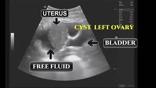 SIMPLE OVARIAN CYST RUPTURED DURING ULTRASOUND [upl. by Ahsaten]