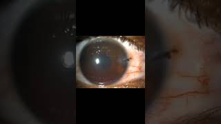 IntraocularForeignBodyCornealLacerationHyphemaIrisTearSomasundaramEyeHospitalKarur [upl. by Hyatt725]