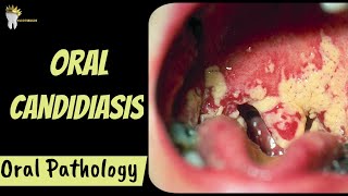 ORAL CANDIDIASIS  Diagnosis and Management  Oral Pathology [upl. by Wesle]