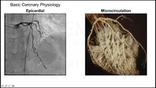 Coronary Microvascular Dysfunction in Contemporary Practice Demystifying Angina w Open Coronaries [upl. by Zach]