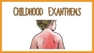 Childhood Exanthems rash [upl. by Nosittam]