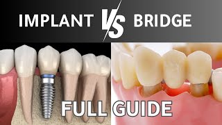 Dental Implants vs Bridges FULL GUIDE  What is the BEST option to replace your teeth [upl. by Arreyt120]