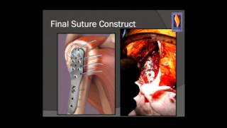 Principles of ORIF for proximal humerus fractures [upl. by Ardnael]