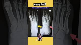 Fracture 5th Metatarsal  Xray Foot shorts xray [upl. by Aubrie]