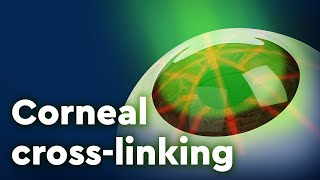 Corneal Collagen Crosslinking and Keratoconus Treatment [upl. by Honan]