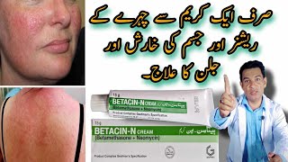 face rashes cream  body rashes cream  betacin n cream  betamethasone  how to treat skin redness [upl. by Cissie]