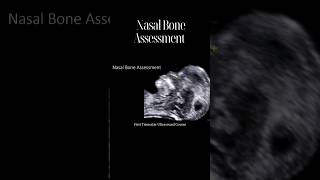 How to Accurately Assess The Fetal Nasal Bone [upl. by Eedissac]