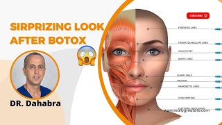 How to fix Spock Eyebrows After Botox  Surprising Look After Botox Eyebrow Lift  Dr Dahabra [upl. by Ahsiuqat]