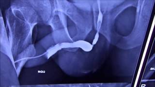 Retrograde Urography RGU for diagnosis of Urethral Stricture [upl. by Nellak]