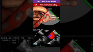 TEE Alternative Views 19 Arch Innominate Artery [upl. by Raddatz]