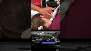 Spinal Accessory Nerve Block Scanning Technique [upl. by Annaek574]