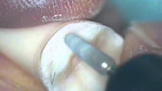 Crown Preparation Tooth Number 30 Part 2 [upl. by Edrock354]