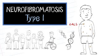 What is Neurofibromatosis Type 1 NF1 [upl. by Ameerak422]