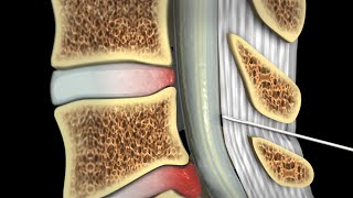 Epidural Steroid Injections [upl. by Thelma]